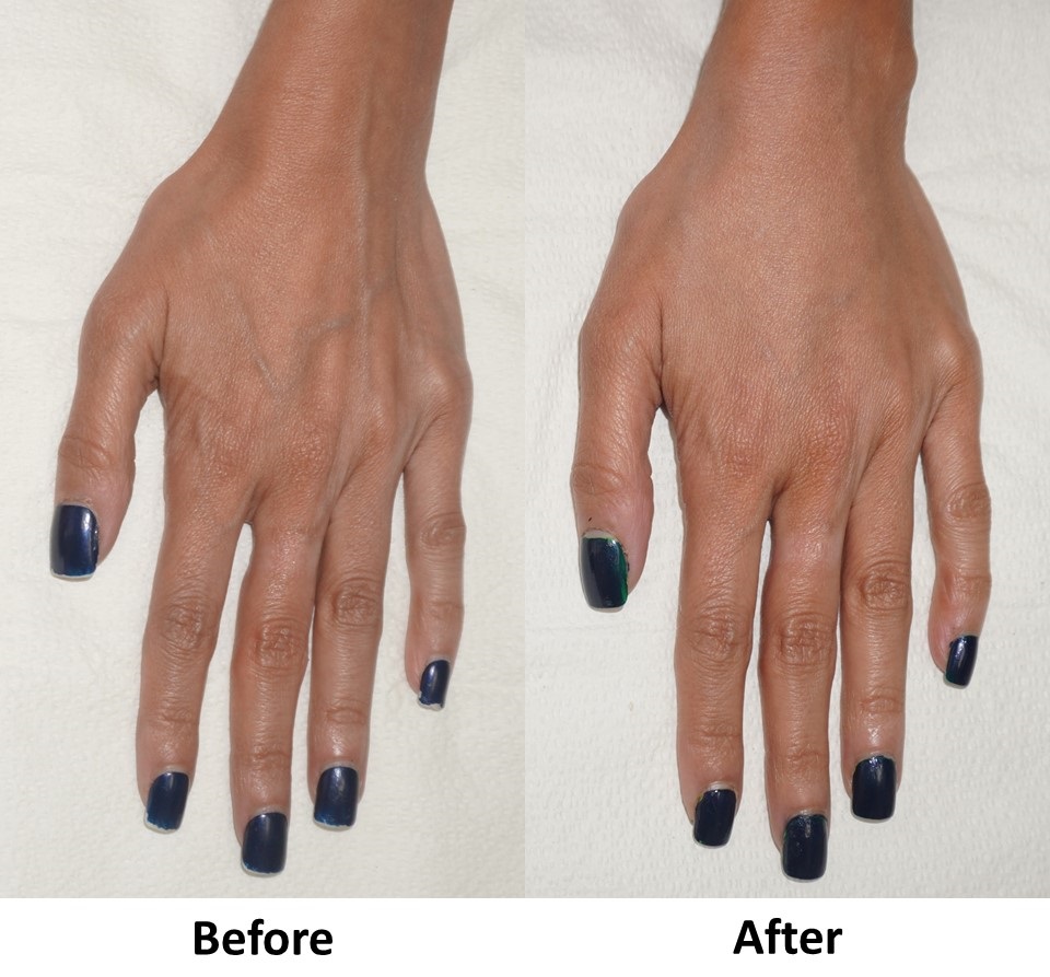 Voluma hands before and after